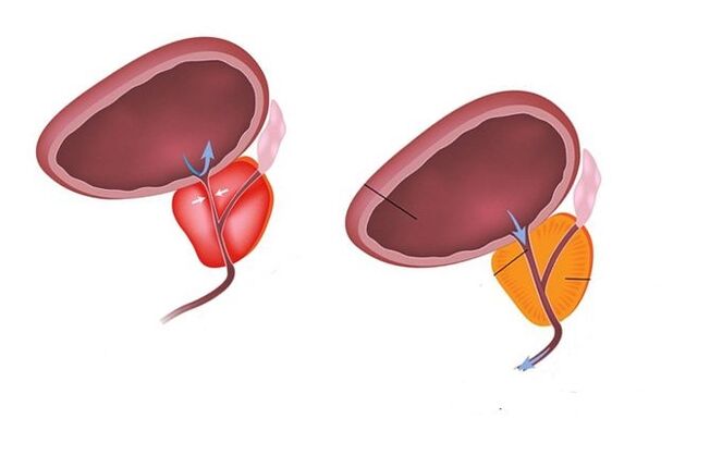 zdravá a chorá prostata