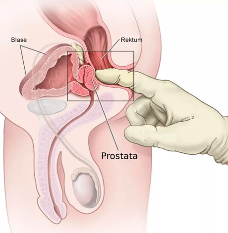 Masáž prostaty
